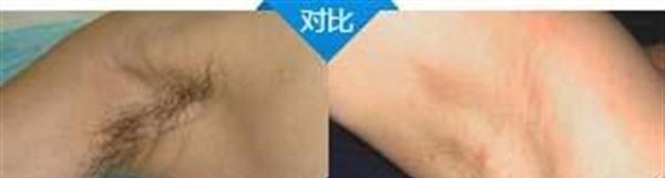 做冷凍<a href=http://www.f3bb6.cn/listinfo-784-0.html target=_blank class=infotextkey>去狐臭</a>多少錢