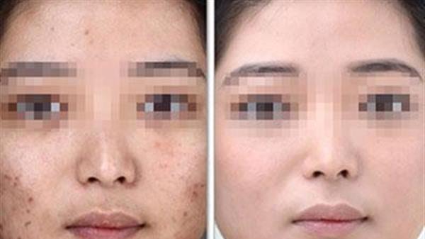 做<a href=http://www.f3bb6.cn/listinfo-781-0.html target=_blank class=infotextkey>祛痘印</a>多少錢