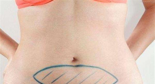 怎么消除妊娠紋