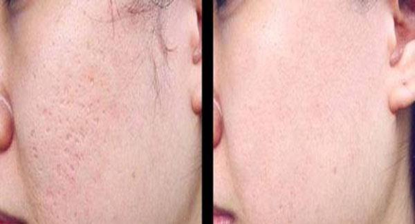 做自體脂肪<a href=http://www.f3bb6.cn/listinfo-797-0.html target=_blank class=infotextkey>去痘疤</a>副作用