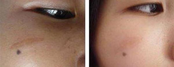 點痣留下的凹陷疤痕怎么祛除