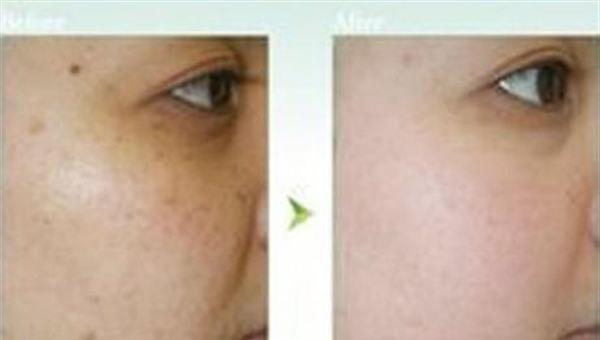 做E光<a href=http://www.f3bb6.cn/listinfo-788-0.html target=_blank class=infotextkey>去黑痣</a>費用大概需要多少