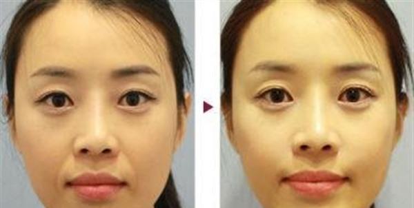 透明質酸<a href=http://www.f3bb6.cn/listinfo-792-0.html target=_blank class=infotextkey>去法令紋</a>效果怎么樣？