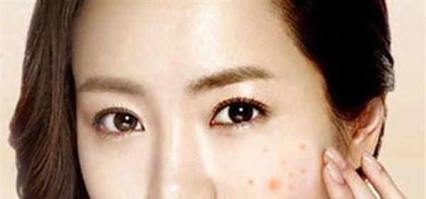 激光去痘印需要多少錢