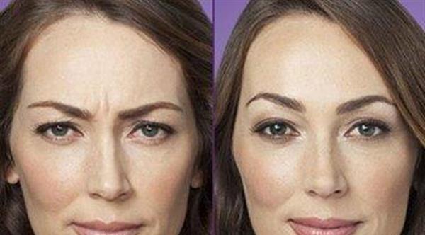 做透明質酸<a href=http://www.f3bb6.cn/listinfo-771-0.html target=_blank class=infotextkey>去眉間紋</a>效果怎么樣