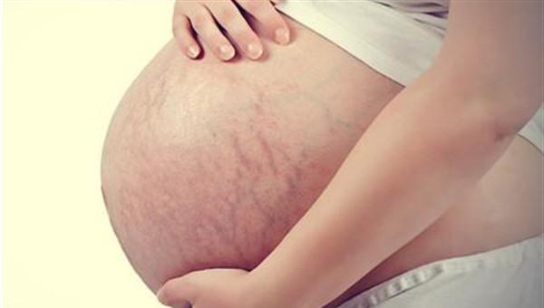 激光修復(fù)妊娠紋效果怎么樣