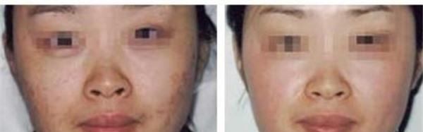 做E光<a href=http://www.f3bb6.cn/listinfo-770-0.html target=_blank class=infotextkey>嫩膚</a>價格多少錢