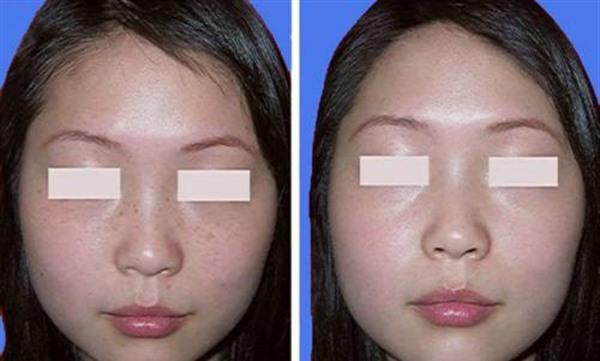 <a href=http://www.f3bb6.cn/listinfo-774-0.html target=_blank class=infotextkey>去雀斑</a>手術安全嗎？