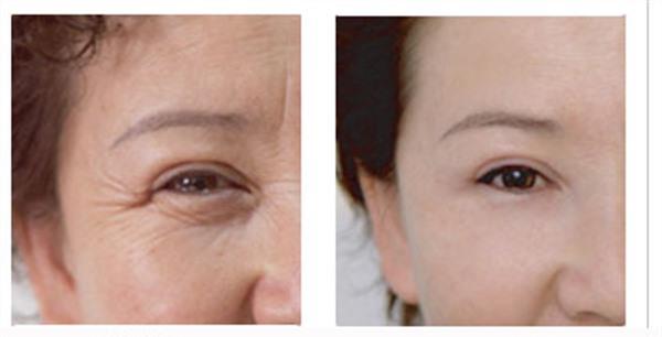 透明質酸<a href=http://www.f3bb6.cn/listinfo-780-0.html target=_blank class=infotextkey>去魚尾紋</a>的效果怎樣啊