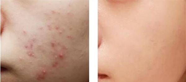 祛痘有效的方法是什么