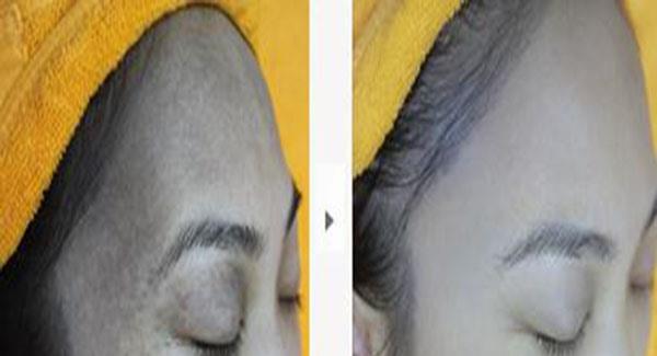 做<a href=http://www.f3bb6.cn/listinfo-799-0.html target=_blank class=infotextkey>去太田痣</a>副作用