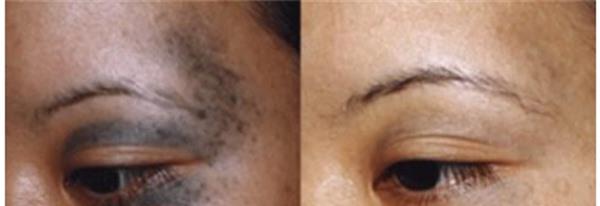 做微晶治療太田痣價格多少錢