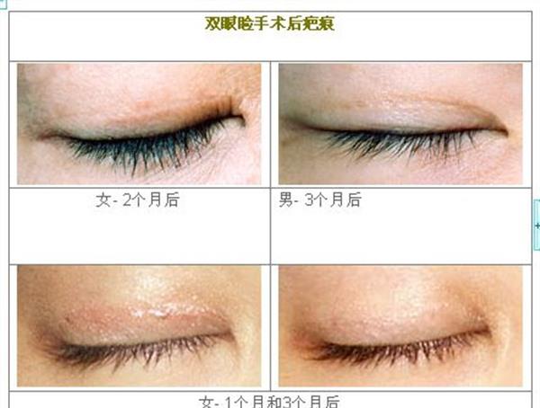 做眼瞼疤痕修復價格是多少