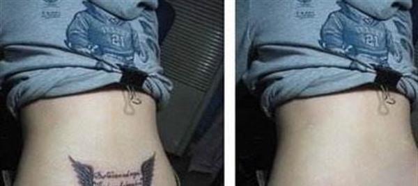 激光<a href=http://www.f3bb6.cn/listinfo-793-0.html target=_blank class=infotextkey>洗紋身</a>大概多少錢