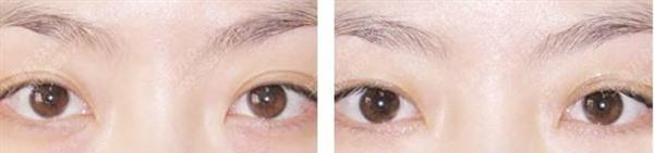 激光<a href=http://www.f3bb6.cn/listinfo-782-0.html target=_blank class=infotextkey>去眼角細(xì)紋</a>手術(shù)安全嗎?