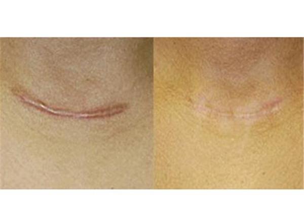 做注射去疤價格