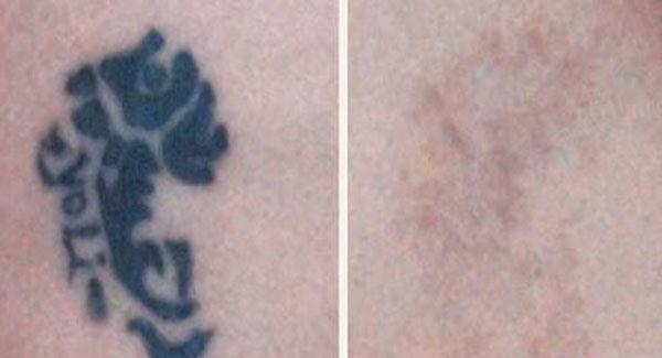 做皮膚磨削去紋身價格貴嗎