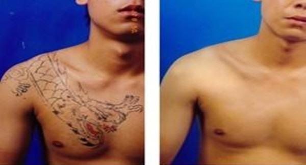 做<a href=http://www.f3bb6.cn/listinfo-793-0.html target=_blank class=infotextkey>洗紋身</a>手術時間是多久？