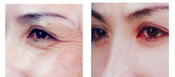 做脈沖光<a href=http://www.f3bb6.cn/listinfo-782-0.html target=_blank class=infotextkey>去眼角細紋</a>效果好不好