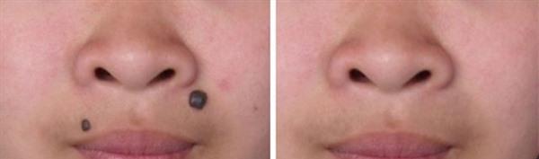 做化學剝脫點痣價格要多少