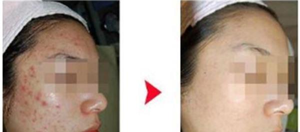 做切開填充治療痘疤價格多少錢