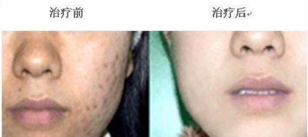 <a href=http://www.f3bb6.cn/listinfo-779-0.html target=_blank class=infotextkey>治療痤瘡</a>手術安全嗎?