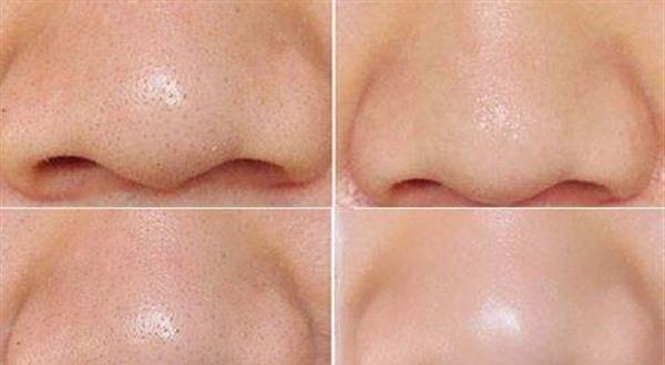 有效<a href=http://www.f3bb6.cn/listinfo-769-0.html target=_blank class=infotextkey>去黑頭</a>的方法是什么