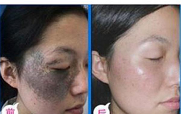 做激光<a href=http://www.f3bb6.cn/listinfo-799-0.html target=_blank class=infotextkey>去太田痣</a>價格