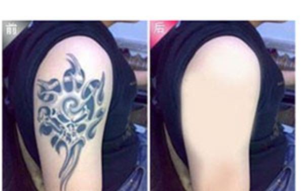 做皮膚磨削去紋身價格