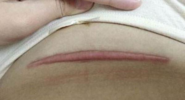 做剖腹產疤痕修復手術注意事項是什么?