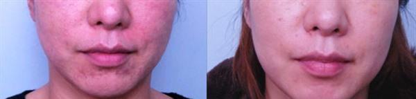 透明質酸<a href=http://www.f3bb6.cn/listinfo-797-0.html target=_blank class=infotextkey>去痘疤</a>手術安全嗎?