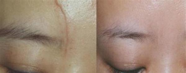 做切除縫合治療痘疤手術多少錢？