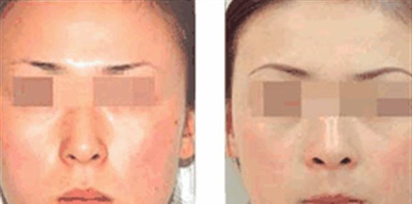 彩光<a href=http://www.f3bb6.cn/listinfo-770-0.html target=_blank class=infotextkey>嫩膚</a>手術注意事項是什么？