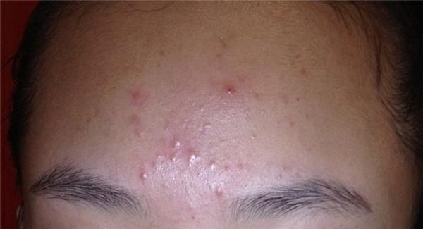 <a href=http://www.f3bb6.cn/listinfo-797-0.html target=_blank class=infotextkey>去痘疤</a>痛么