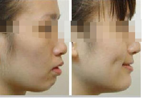 <a href=http://www.f3bb6.cn/listinfo-637-0.html target=_blank class=infotextkey>酒窩整形</a>手術是否安全