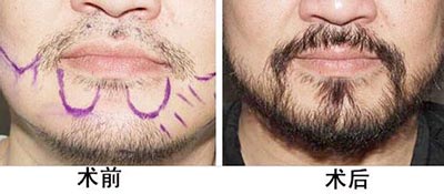 影響胡須種植術的價格因素