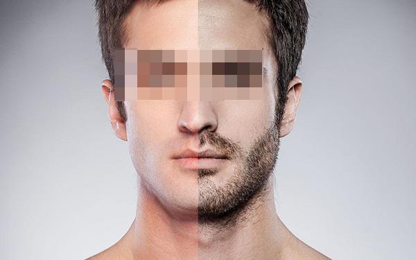 胡須種植后怎么緩解疼痛