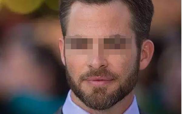 胡須種植術的術前術后注意事項