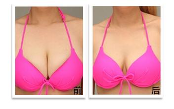 <a href=http://www.f3bb6.cn/listinfo-617-0.html target=_blank class=infotextkey>巨乳縮小</a>術的手術過程及護理