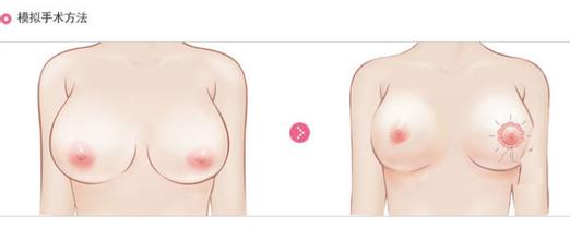 <a href=http://www.f3bb6.cn/listinfo-617-0.html target=_blank class=infotextkey>巨乳縮小</a>術的價格及手術準備工作