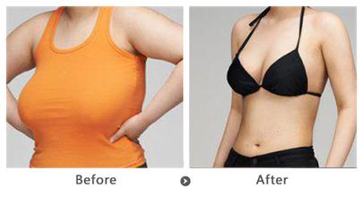 <a href=http://www.f3bb6.cn/listinfo-617-0.html target=_blank class=infotextkey>巨乳縮小</a>術(shù)的副作用及手術(shù)要求