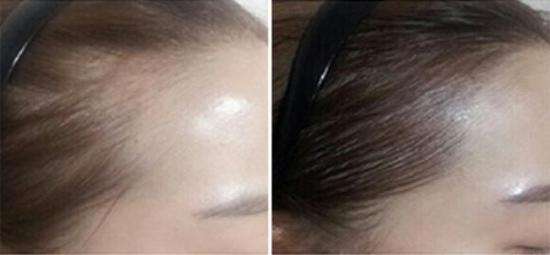 發(fā)際線過高或過低要如何改善