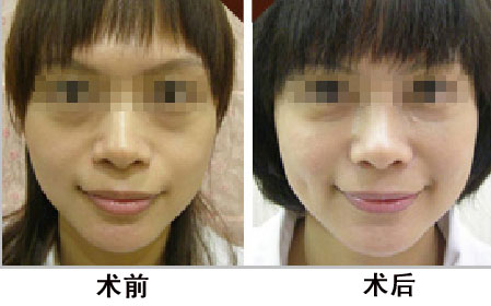 酒窩成形手術過程中會不會切除皮膚