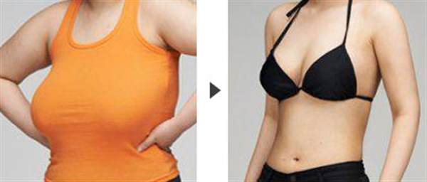 巨乳如何縮小乳頭乳暈?zāi)?  style=