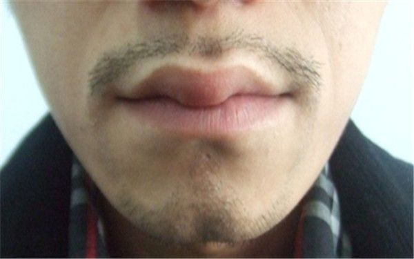 胡須種植術是否安全呢