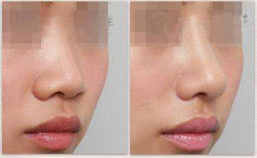 韓式<a href=http://www.f3bb6.cn/listinfo-737-0.html target=_blank class=infotextkey>隆鼻</a>整行手術(shù)好不好