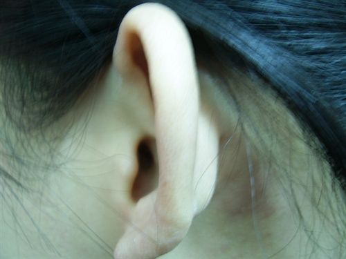 跟專家詳細了解招風耳整形的方法