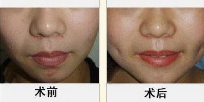 酒窩成形術的手術過程及適應人群