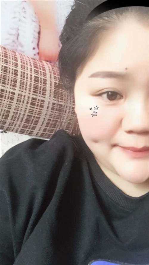 酒窩成形對面部表情有啥影響