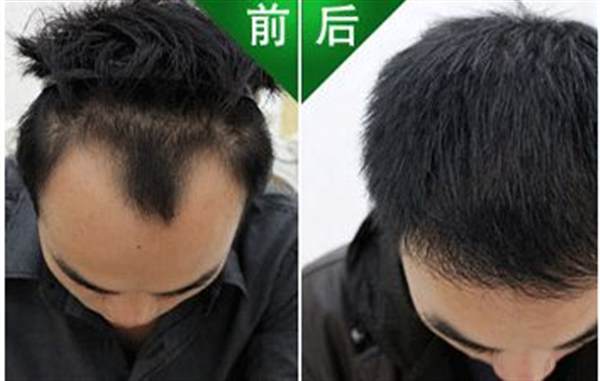 如何<a href=http://www.f3bb6.cn/listinfo-662-0.html target=_blank class=infotextkey>治療脫發(fā)</a>